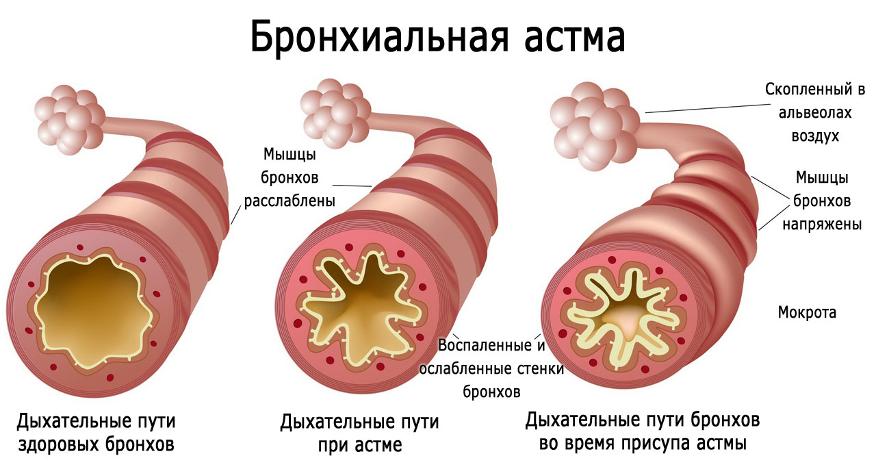 Приступ бронхиальной астмы, симптомы, что делать при приступе?